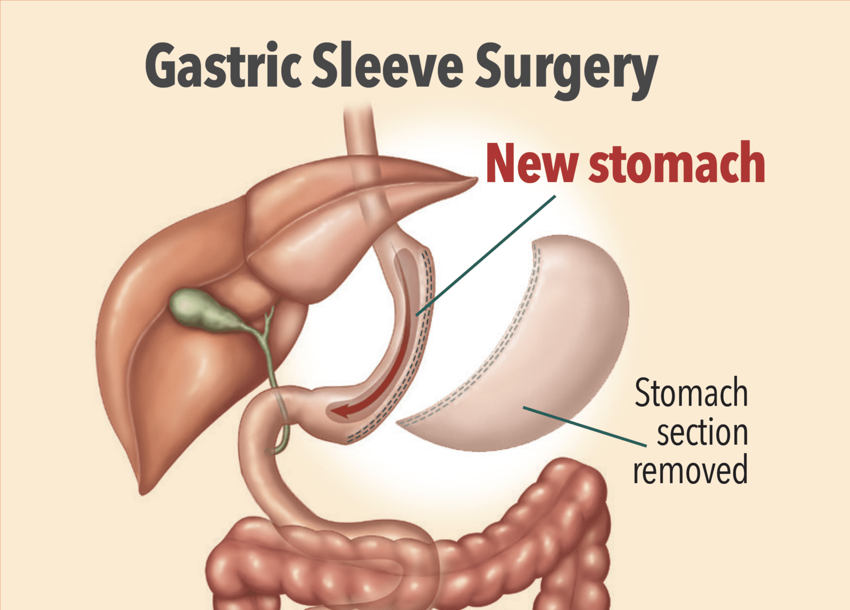 What Is a Gastric Sleeve Surgery?